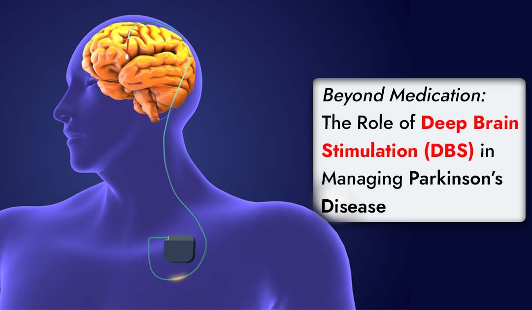 Beyond Medication: The Role of Deep Brain Stimulation (DBS) in Managing Parkinson’s Disease