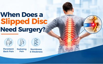 Can a Slipped Disc Be Treated Without Surgery?